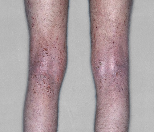 Patient legs before and after.