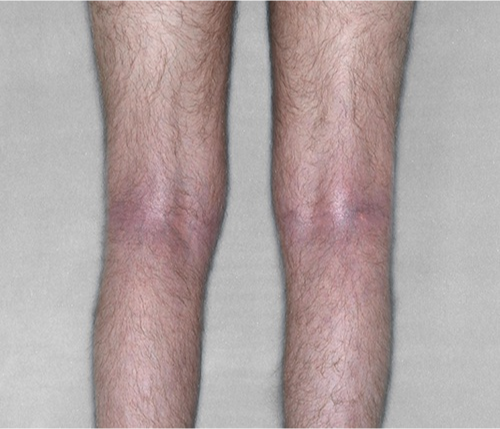 Patient legs before and after.