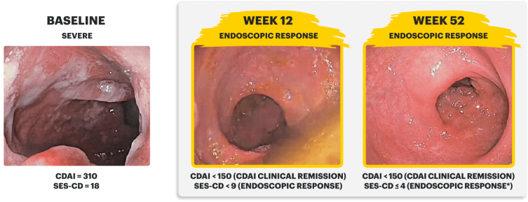 Endoscopy images of a clinical trial patient at baseline (Week 0), Induction (Week 12), and Maintenance (Week 52).