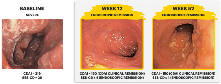 Endoscopy images of a clinical trial patient at baseline (Week 0), Induction (Week 12), and Maintenance (Week 52).