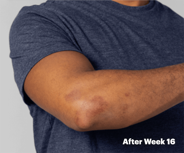 Clear skin on arm after week 16 on RINVOQ®.