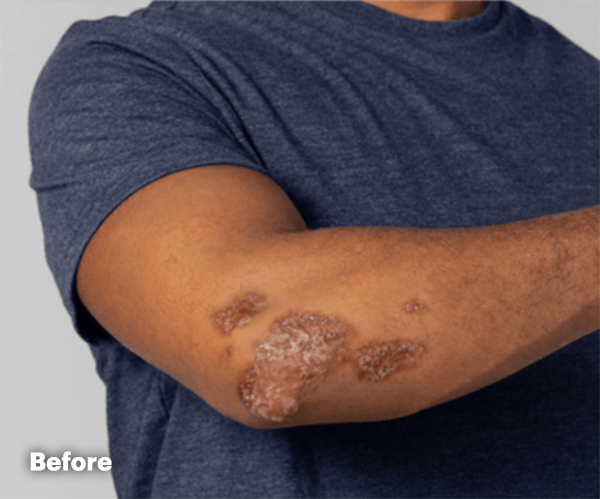 Psoriatic Arthritis on arm before treatment with RINVOQ®.