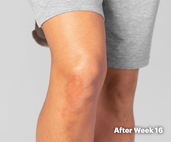 Clearer skin on knee after week 16 on RINVOQ®.