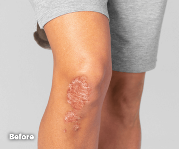 Psoriatic Arthritis on knee before treatment with RINVOQ®.